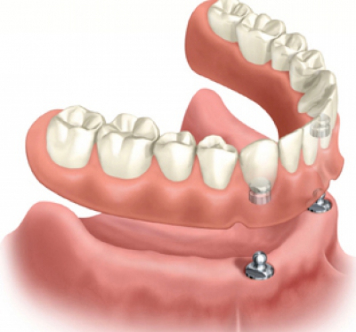 PRÓTESE SOBRE IMPLANTES Odontocap Clínicas Odontológicas Aparelho ortodôntico Tratamento